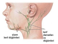 Lenfoma Hastalığı Belirtileri ve Tedavisi