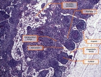 Marjinal Zon Lenfoma Belirtileri ve Tedavisi
