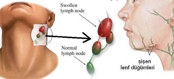 Kasıkta Lenfoma Belirtileri ve Tedavisi