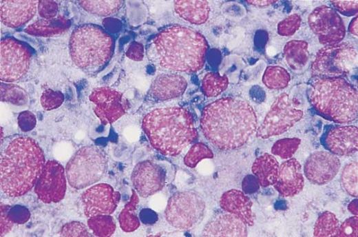 Diffüz Büyük B Hücreli Lenfoma